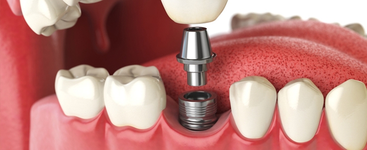 52% popust na zobni implantat s pregledom čeljusti in m - Kuponko.si