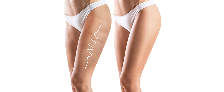 Limfna drenaža, bodywraping, oblikovanje telesa - Kuponko.si