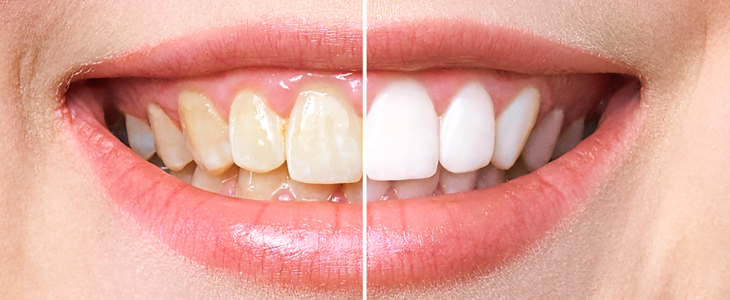Beauty Dent: Premim beljenje zob Pearlsmile - Kuponko.si
