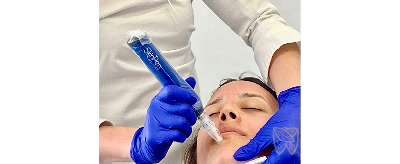 Dent Natura: tretma SkinPen, microneedling - Kuponko.si