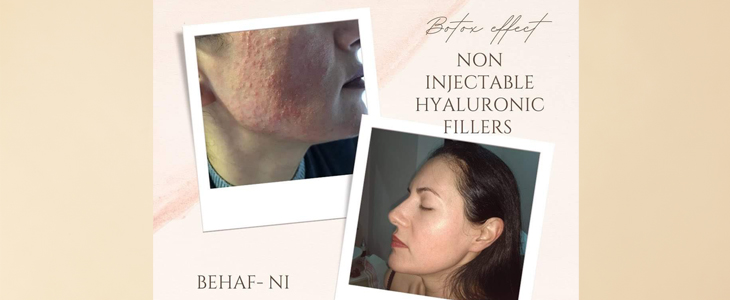 Vbrizgavanje BOTOX EFFECT hialuronskih polnil brez igel - Kuponko.si