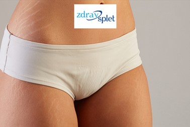 Zdrav splet, zmanjševanje strij, carboxy Zdrav splet, zmanjševanje strij, carboxy