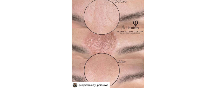 Project Beauty, pomlajevanje kože s plasma tretmajem - Kuponko.si