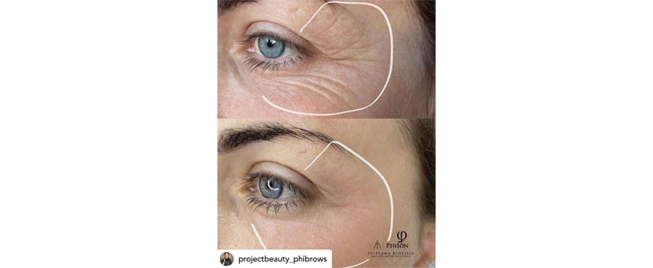 Project Beauty, pomlajevanje kože s plasma tretmajem - Kuponko.si