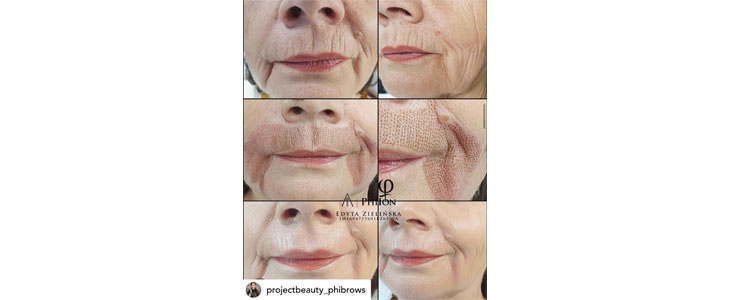 Project Beauty, pomlajevanje kože s plasma tretmajem - Kuponko.si