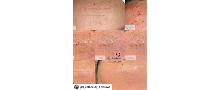 Project Beauty, pomlajevanje kože s plasma tretmajem - Kuponko.si