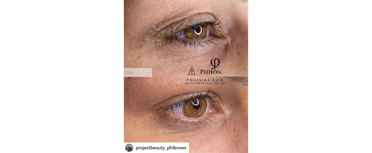 Project Beauty, pomlajevanje kože s plasma tretmajem - Kuponko.si