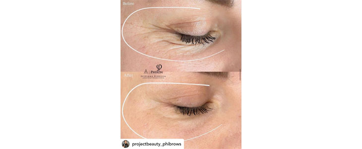 Project Beauty, pomlajevanje kože s plasma tretmajem - Kuponko.si