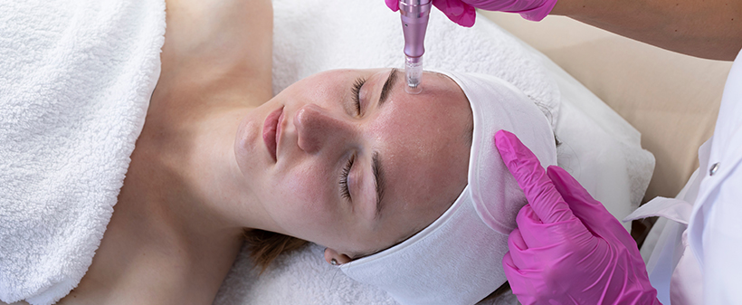 Body art & Beauty: Microneedling obraza - Kuponko.si