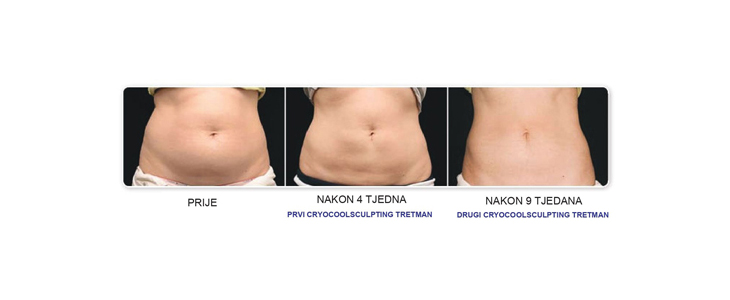 Tajna ljepote: 4D Cryocoolsculpting 360 Pro - Kuponko.si