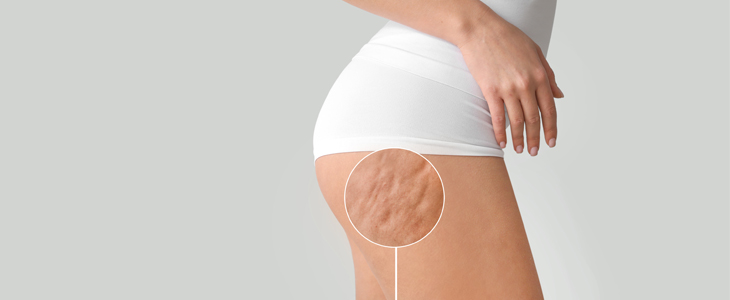 Monerai; LPG Endermologie za preoblikovanje postave - Kuponko.si