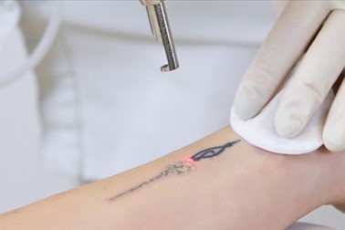 Ellite salon: profesionalno odstranjevanje tattooja