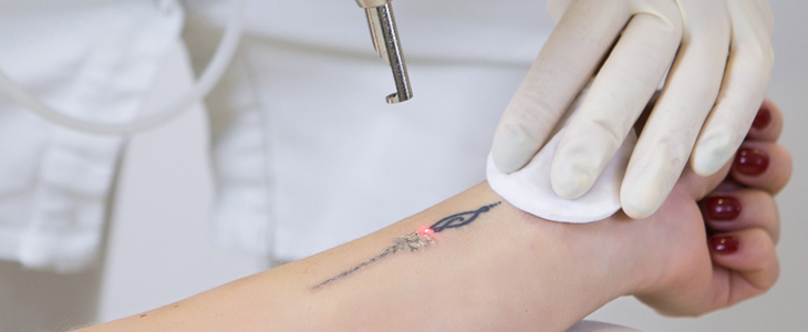 Ellite salon: profesionalno odstranjevanje tattooja - Kuponko.si