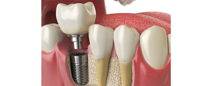 Ordinacija dr. med. dent. Aleksandar Kovačević: implant - Kuponko.si