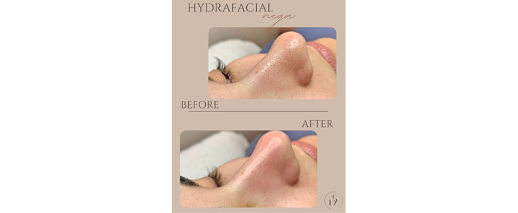 D.S. Beauty Salon; Hydrafacial 7v1 nega - Kuponko.si