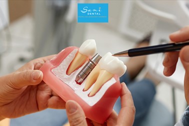 Sani Dental: vstavitev zobnega implantata