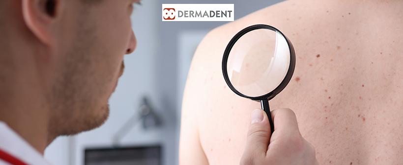Dermatologija Dermadent: pregled kožnih znamenj - Kuponko.si