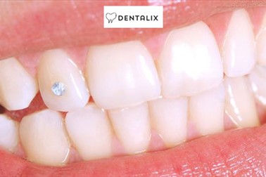 Dentalix; čiščenje zobnega kamna Dentalix; čiščenje zobnega kamna