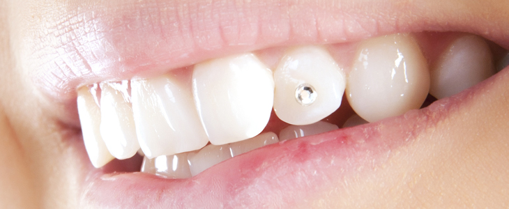Dentalix; čiščenje zobnega kamna - Kuponko.si