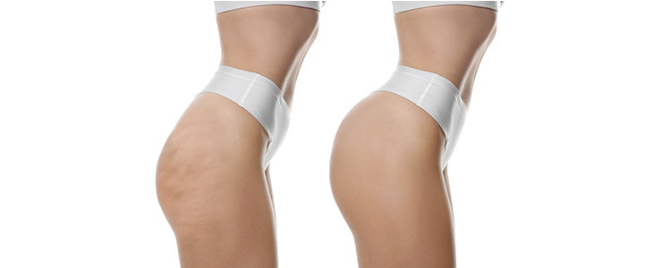 Terme Ptuj, wellness Valens Augusta: lipo detox - Kuponko.si