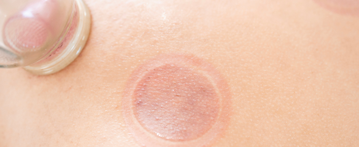 Arina Studio Maribor, cupping masaža - Kuponko.si