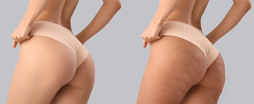 Valentyna massage, ročna anticelulitni masaža  - Kuponko.si