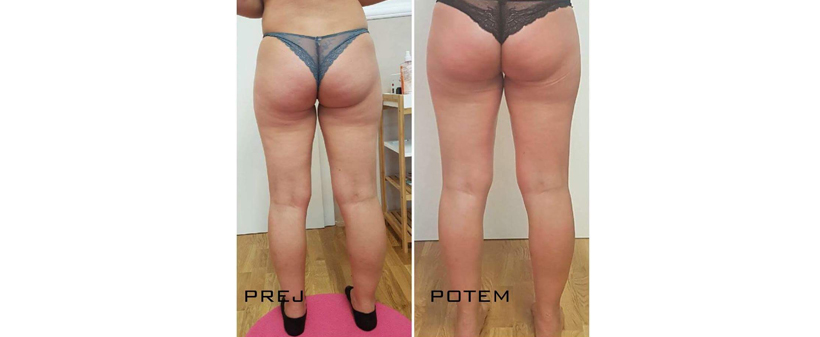 La Novia Kozmetika: paket 6 maderoterapij - Kuponko.si