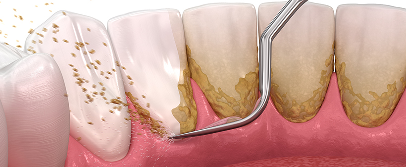 Zobozdravnica Tea: čiščenje zobnega kamna - Kuponko.si