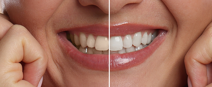 Zobozdravstvu ZOA, beljenje zob in stomatološki pregled - Kuponko.si