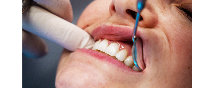 Dentpoint, čiščenje zobnega kamna - Kuponko.si