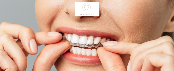 Dentpoint ordinacija, beljenje zob s folijami - Kuponko.si