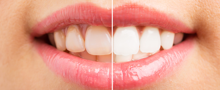 Dentpoint ordinacija, beljenje zob s folijami - Kuponko.si