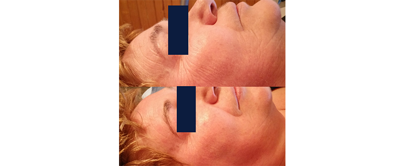 Tesla Center, nega obraza proti gubam - Kuponko.si