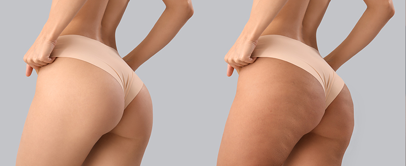MM Lux Skin Laser: 45-minutna anticelulitna masaža - Kuponko.si