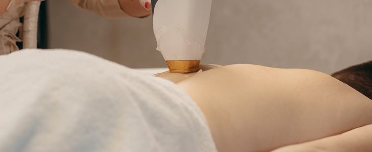 Nailash beauty studio, Lasersko odstranjevanje dlačic - Kuponko.si